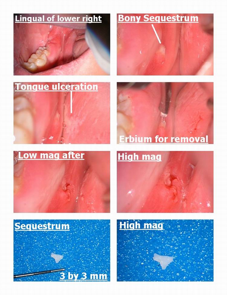 Bony Sequestrum removal .jpg